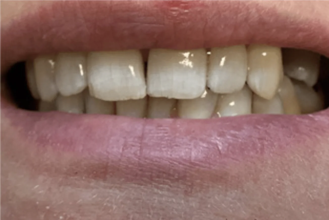 A close-up photo of a person's mouth, showing clean, aligned teeth and slightly parted lips.