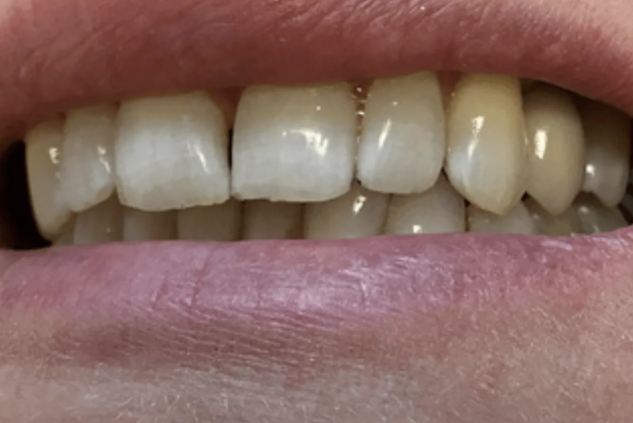 Photo of a close-up smile showing upper and lower teeth with light pink lips.