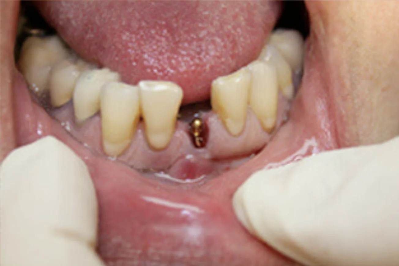 Close-up photo of a mouth with missing teeth and gums showing dental work.