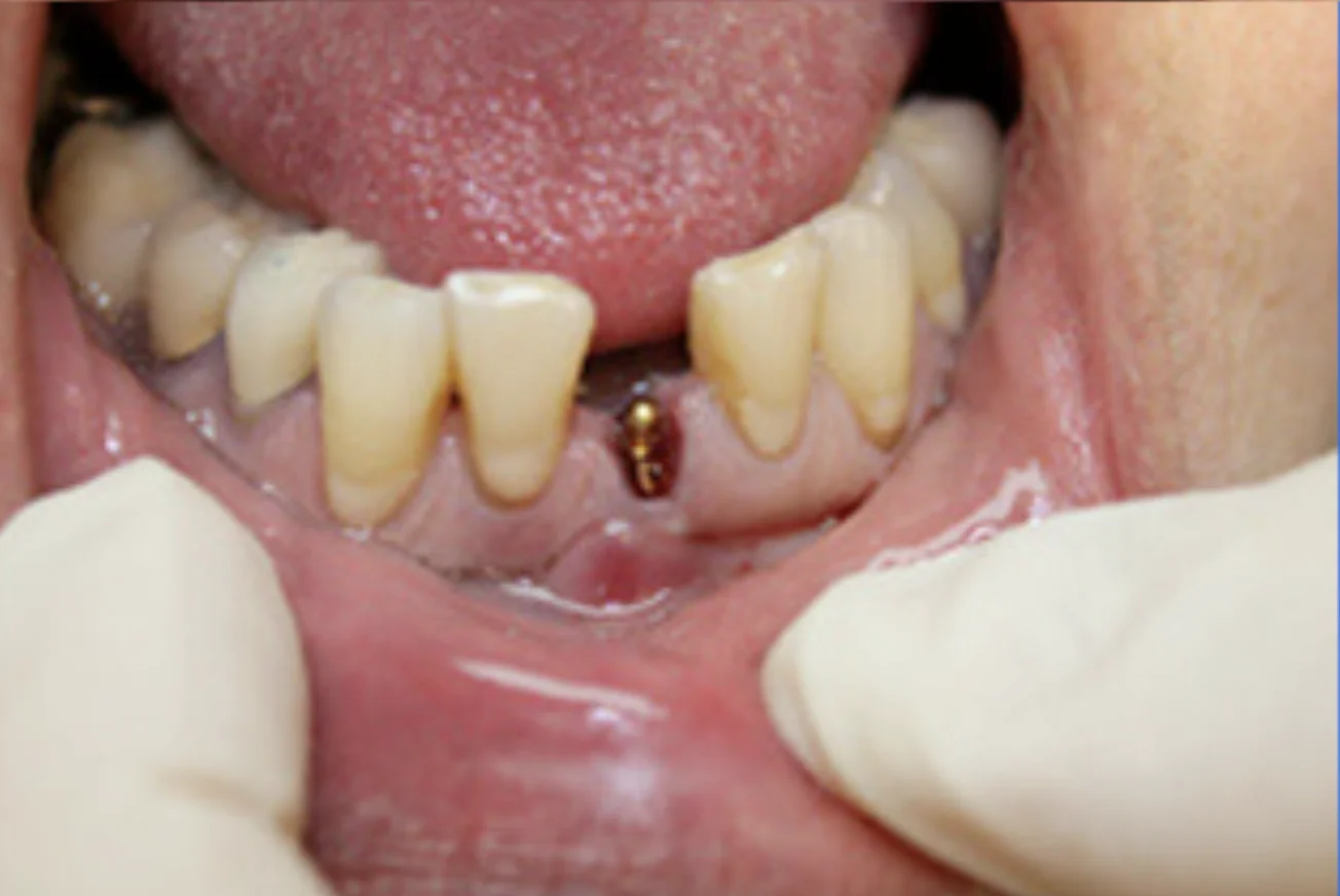 A photo showing a close-up of a mouth with visible dental issues and missing lower teeth.