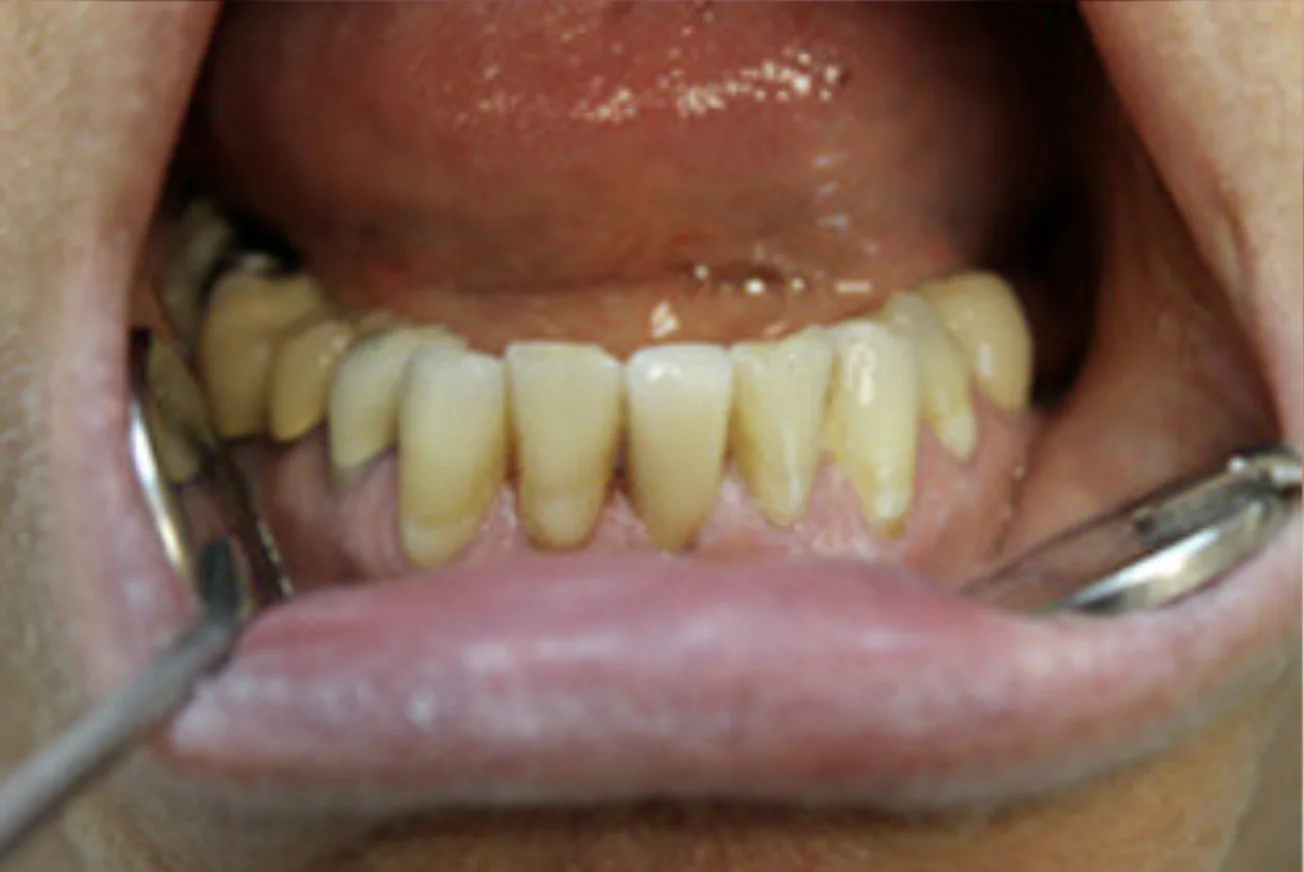 A close-up photo of a person's open mouth showing their teeth and dental tools.
