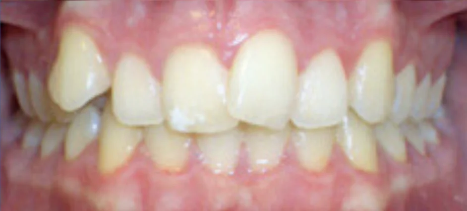 A close-up photo of a set of human teeth showing the top and bottom rows.