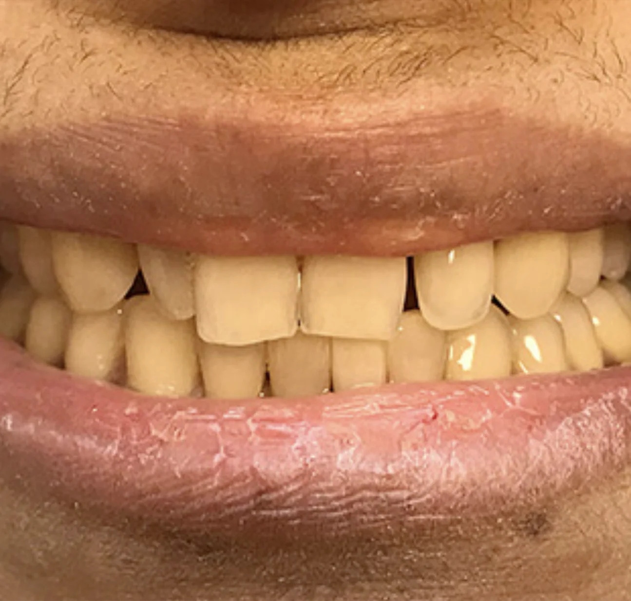 A close-up photo of a person's smiling mouth with slightly dry lips and visible teeth.